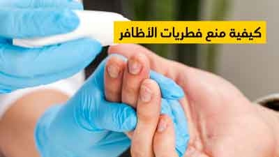 كيفية منع فطريات الأظافر