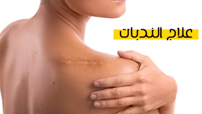 علاج الندبات