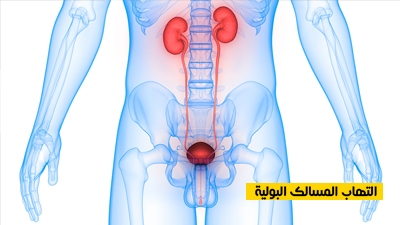 التهاب المسالك البولية