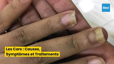 Maîtriser les Onychomycoses : Diagnostic, Traitement et Prévention
