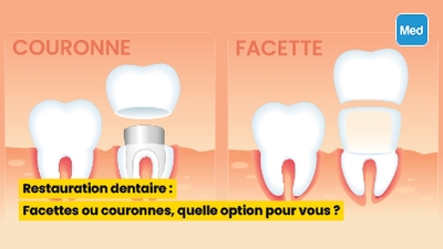 Restauration dentaire : Facettes ou couronnes, quelle option pour vous ?