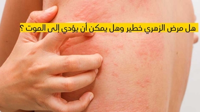 هل مرض الزهري خطير وهل يمكن أن يؤدي إلى الموت ؟