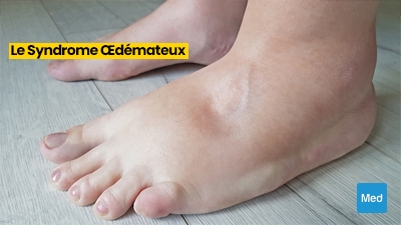 Comprendre le Syndrome Œdémateux : Symptômes, Causes, Diagnostic et Traitement