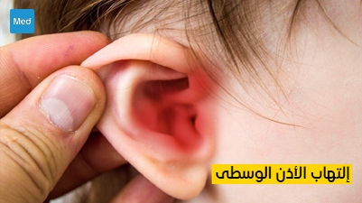 التهاب الأذن الوسطى