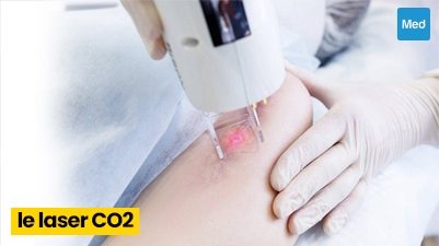 Laser CO2 pour les taches pigmentaires et les cicatrices d’acné