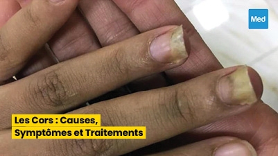 Maîtriser les Onychomycoses : Diagnostic, Traitement et Prévention