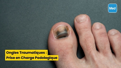 Ongles Traumatiques : Prise en Charge Podologique