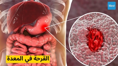 القرحة في المعدة 