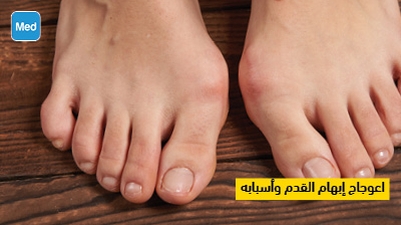 اعوجاج إبهام القدم وأسبابه 