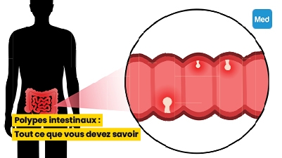 Polypes intestinaux : Tout ce que vous devez savoir