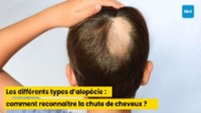Les différents types d’alopécie : comment reconnaître la chute de cheveux ?